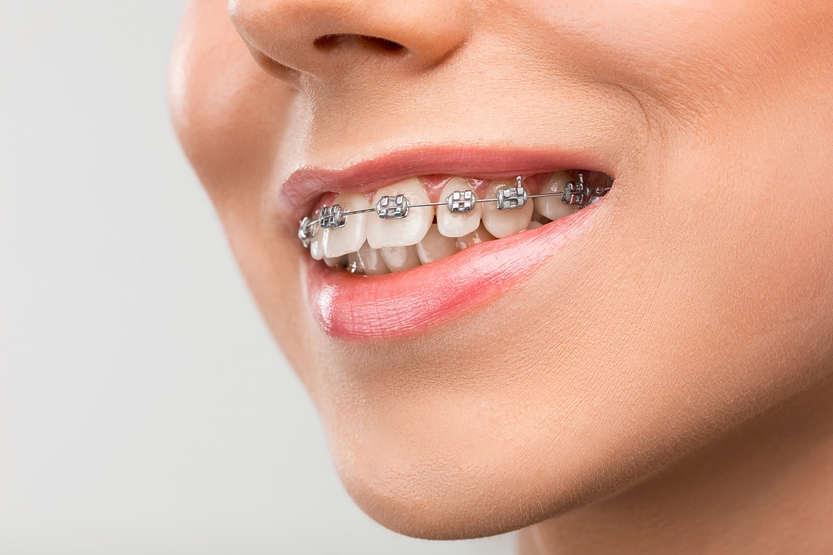 The Single Most Important Item Post Braces Treatment