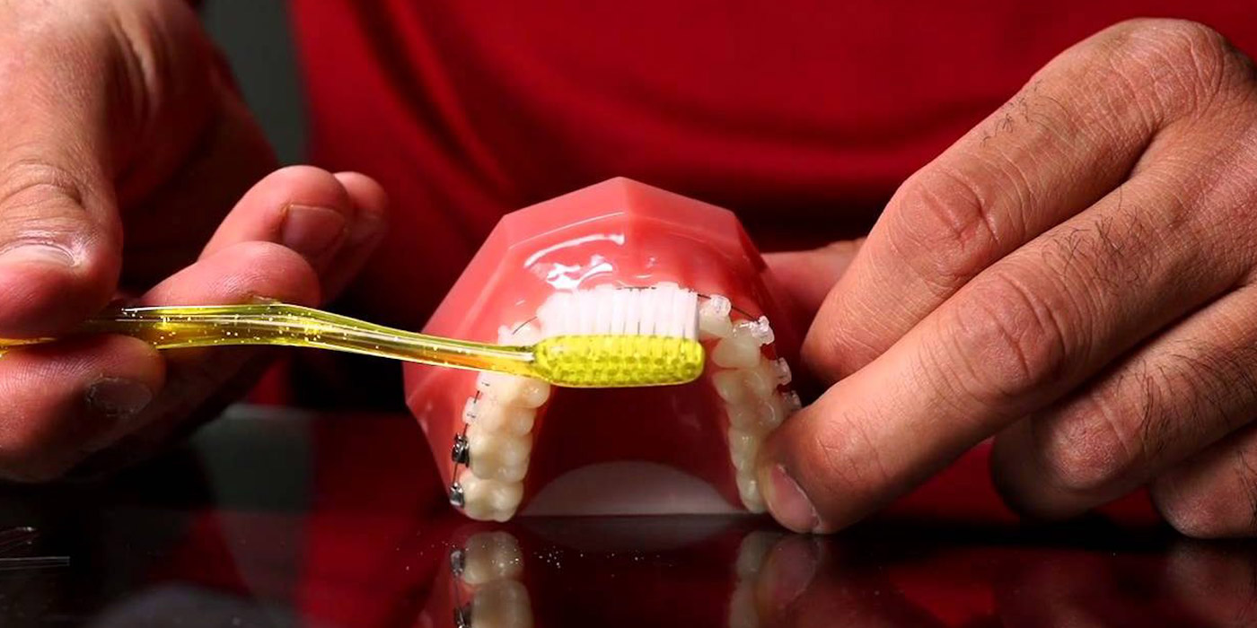 How To Clean Your Teeth While Wearing Braces