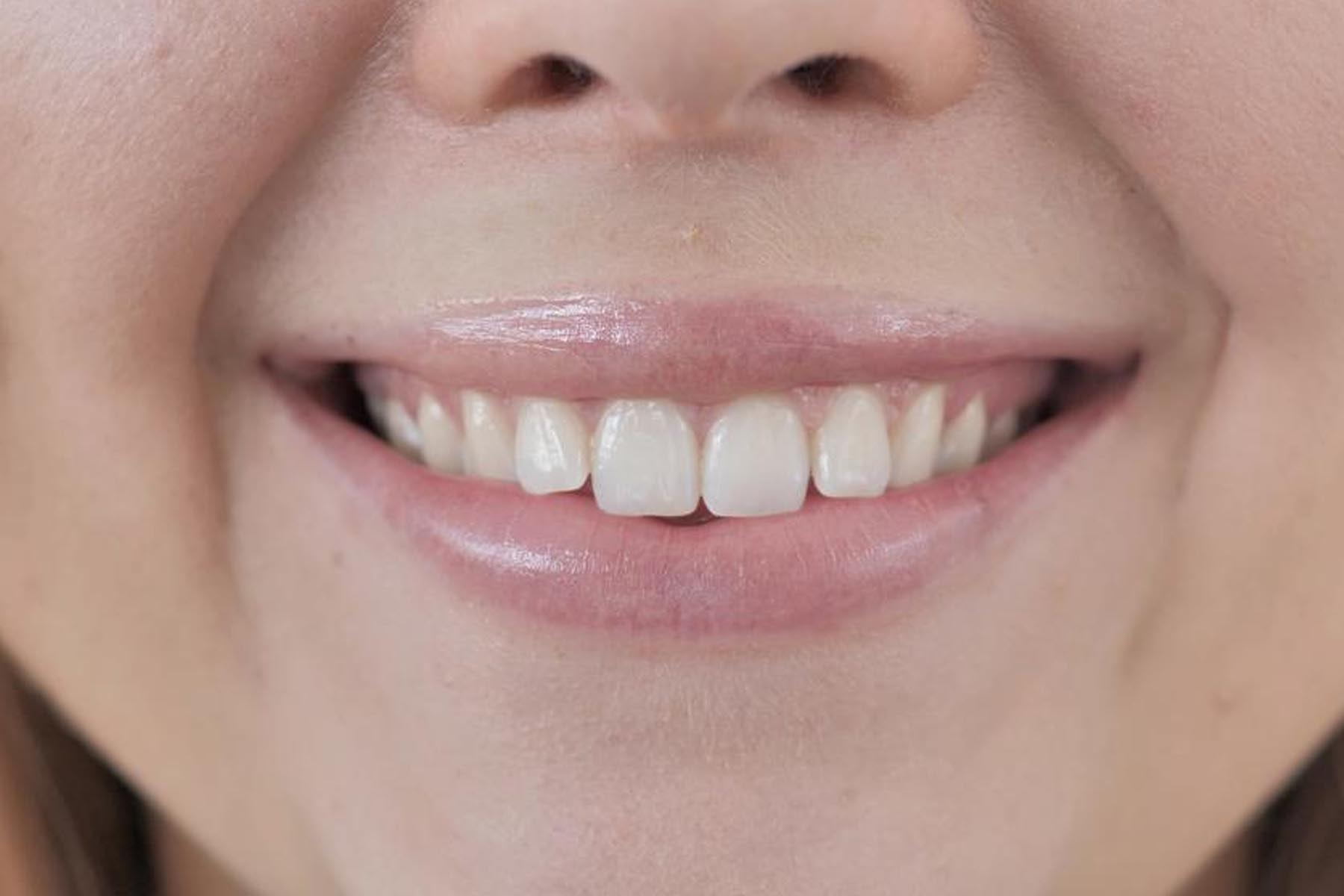 tooth shaping and contouring