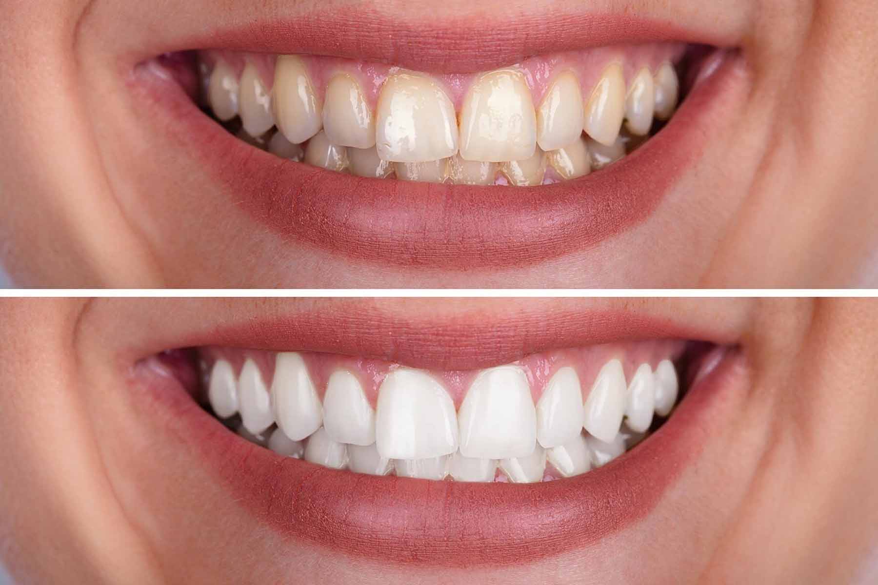 whitening your teeth