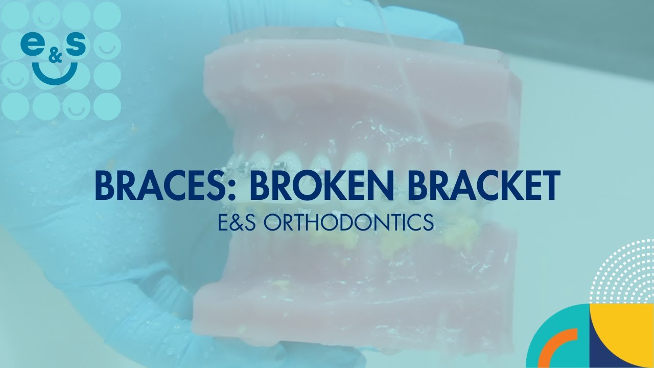 Braces: Managing Broken Brackets