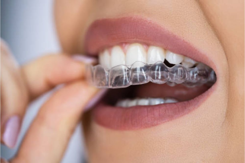 How Quickly Do Teeth Move Back After Invisalign?