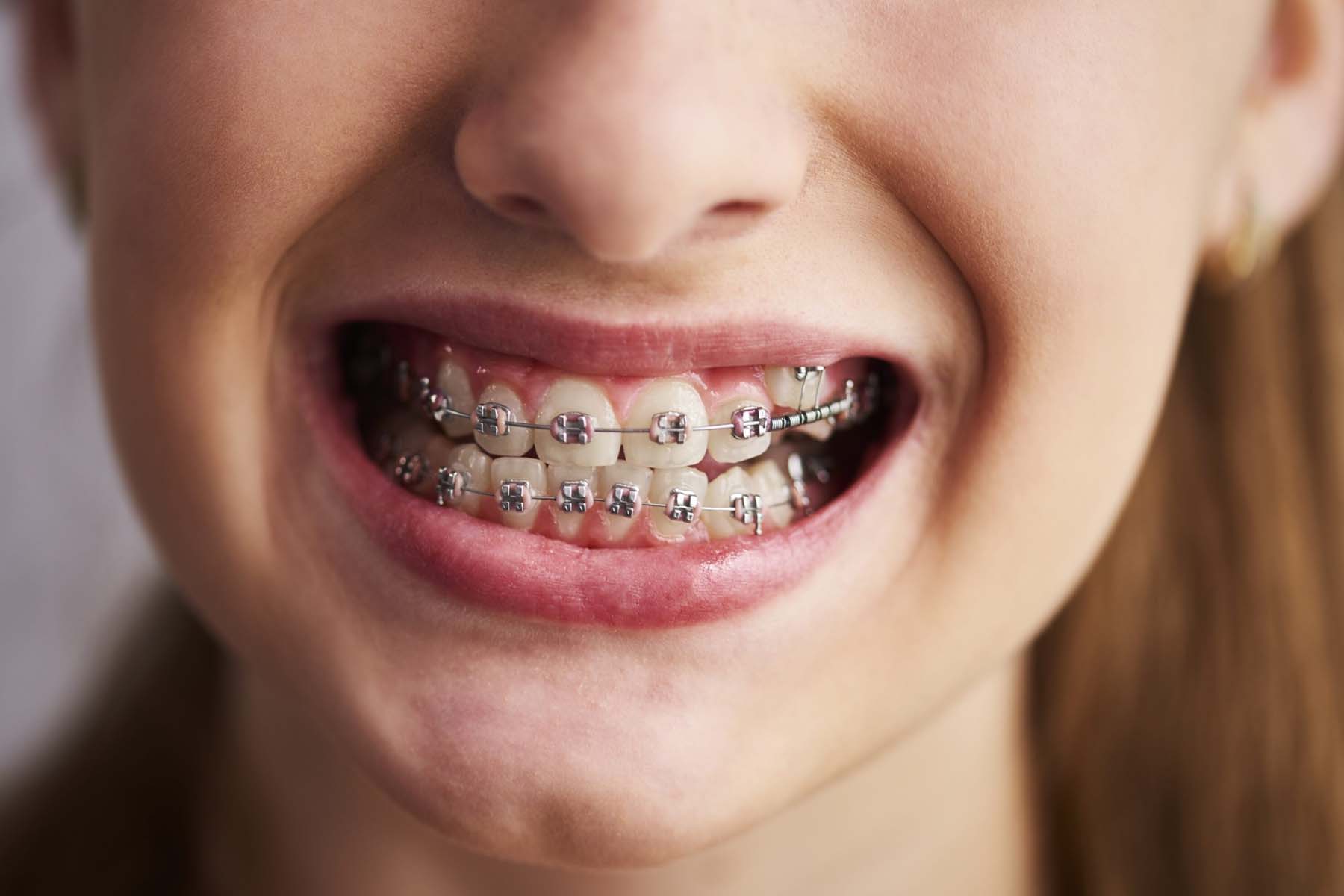 How Long Do You Have To Wear Braces?