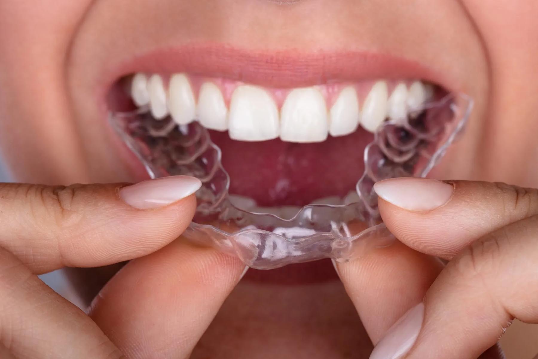 When Does Invisalign Stop Feeling Weird?